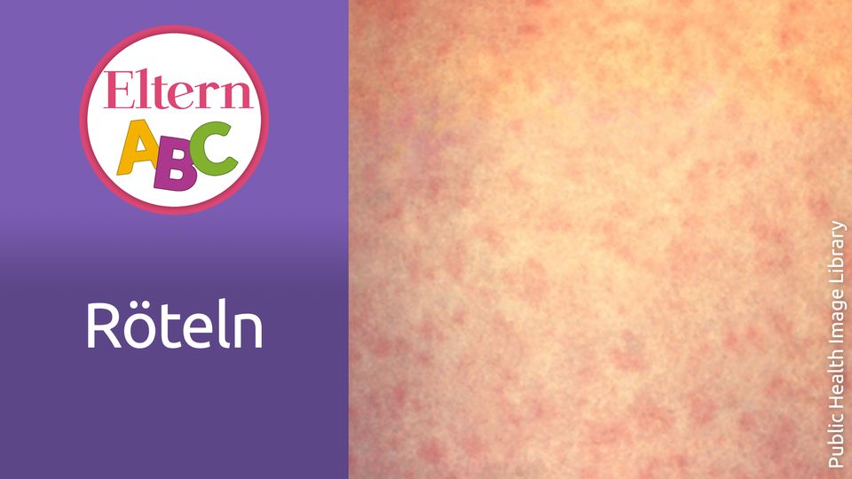 R teln Symptome Wie Erkennt Man Die Kinderkrankheit Eltern de