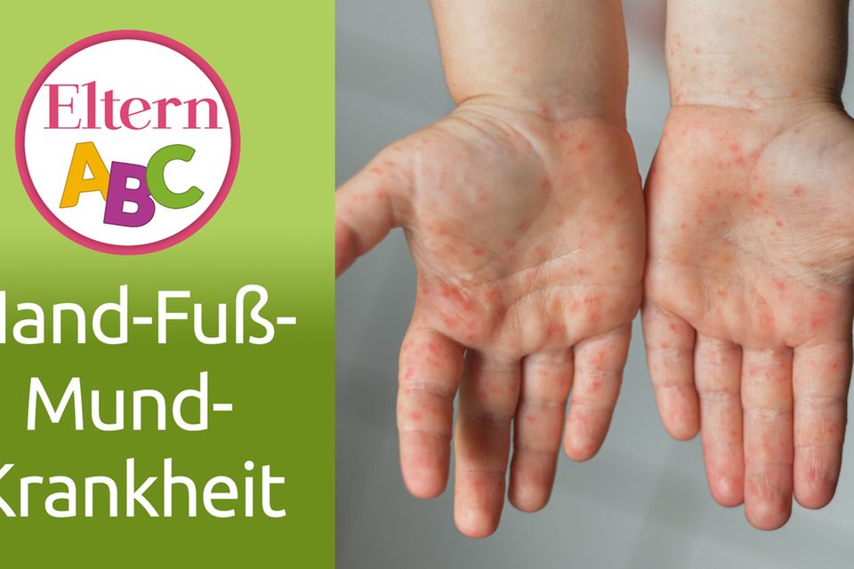 Hand-Fuß-Mund