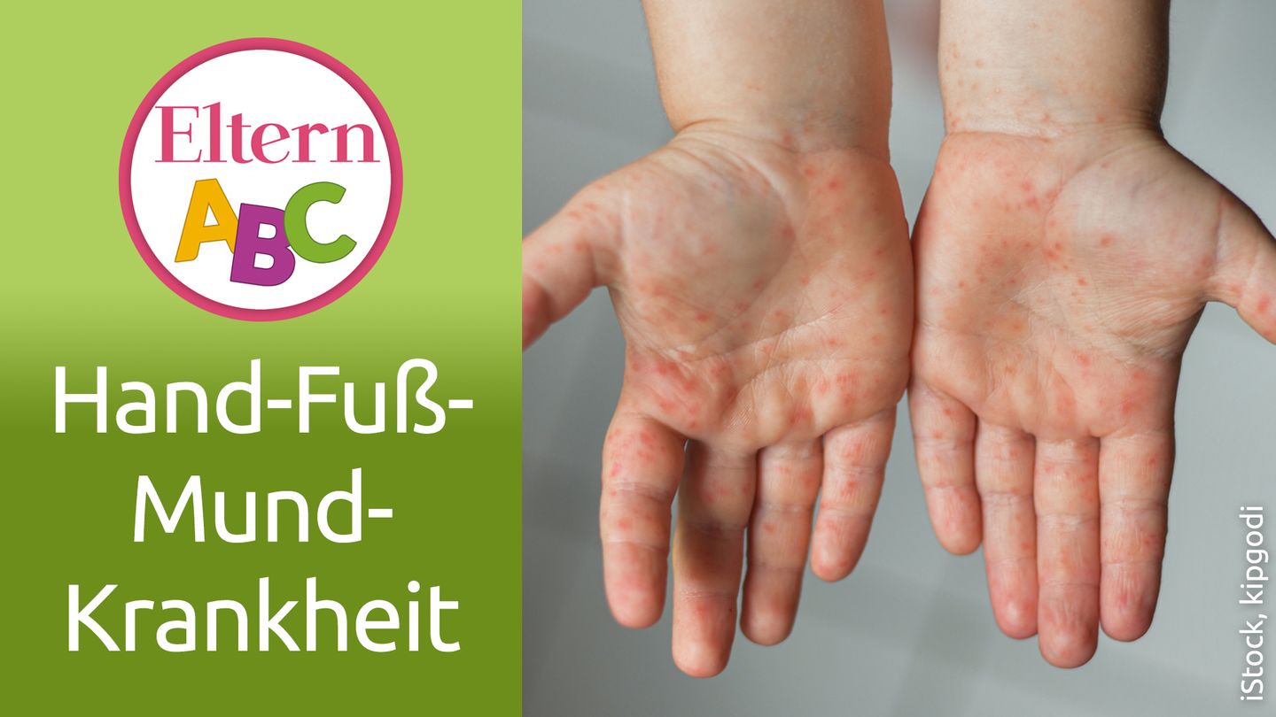 Eltern ABC HandFußMundKrankheit Eltern.de Eltern ABC HandFußMundKrankheit Eltern.de