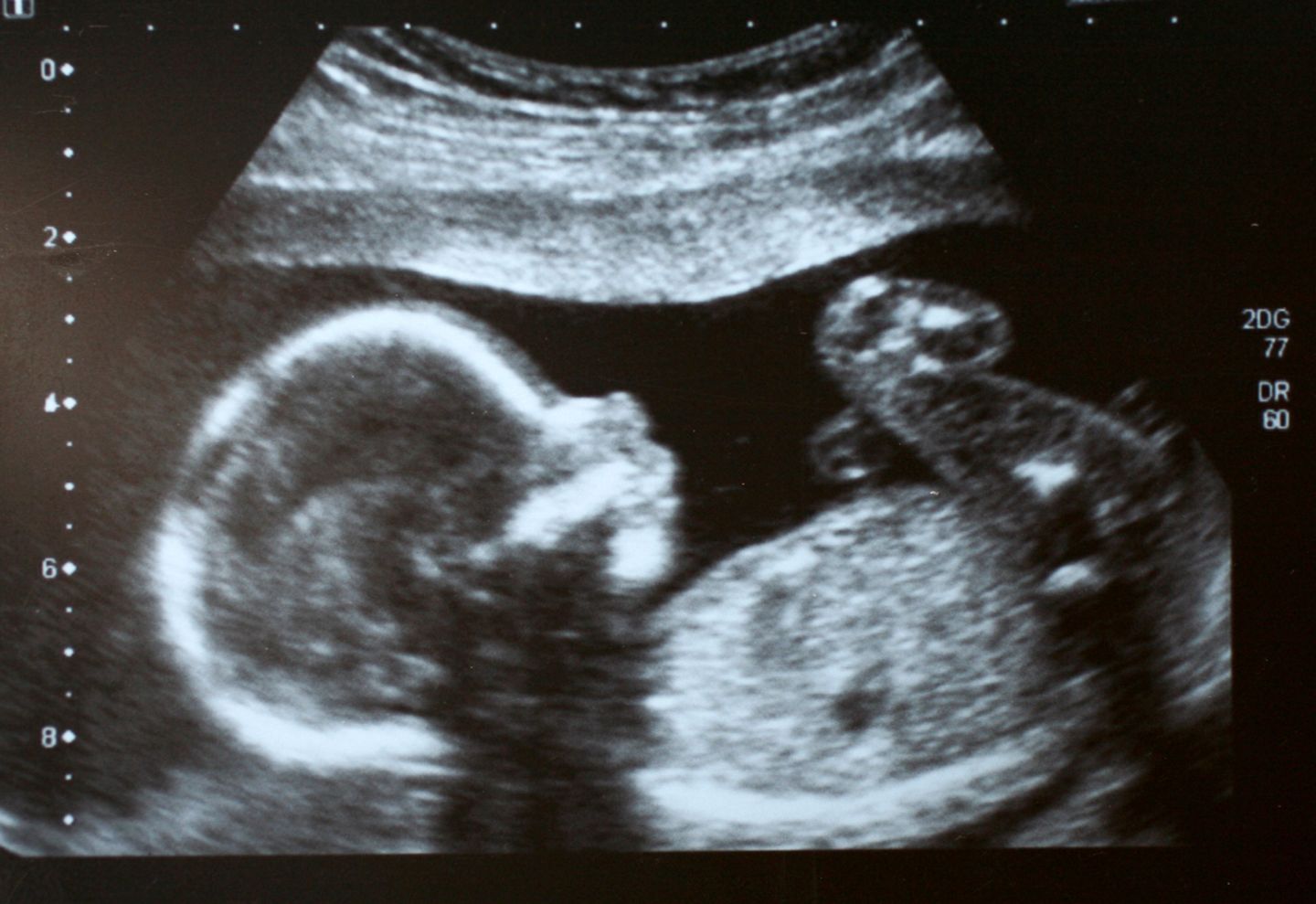 BloggerMumof3Boys, Kaiserschnitt BloggerMumof3Boys, Kaiserschnitt