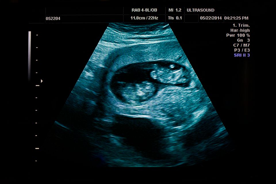 Ultraschallbild-Zwillinge-im-Mutterleib