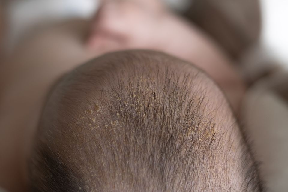 Baby mit trockener Kopfhaut