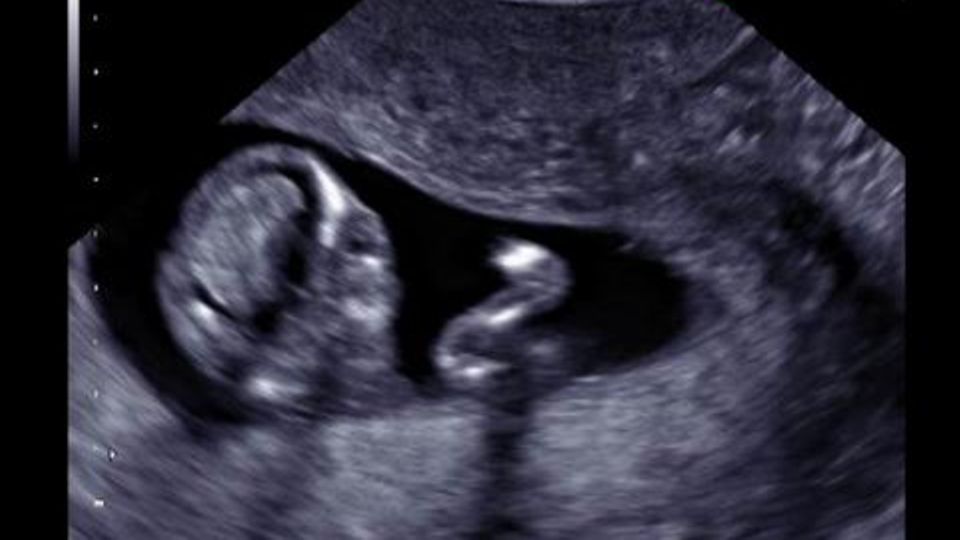 Ohne schwangerschaft gebärmutter ultraschall Ultraschall gegen