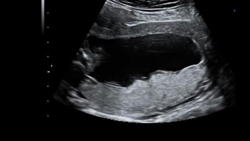 Pränataldiagnostik: Chorionzottenbiopsie: Der frühe Einblick in die Gene des Babys