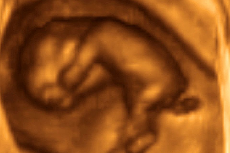 Schwangerschaft ultraschall gebärmutter ohne Gebärmutter