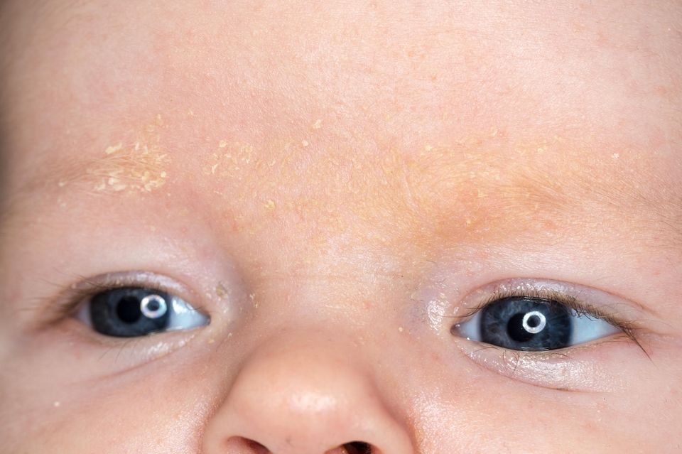 Babygwsicht mit Milchschorf auf der Stirn