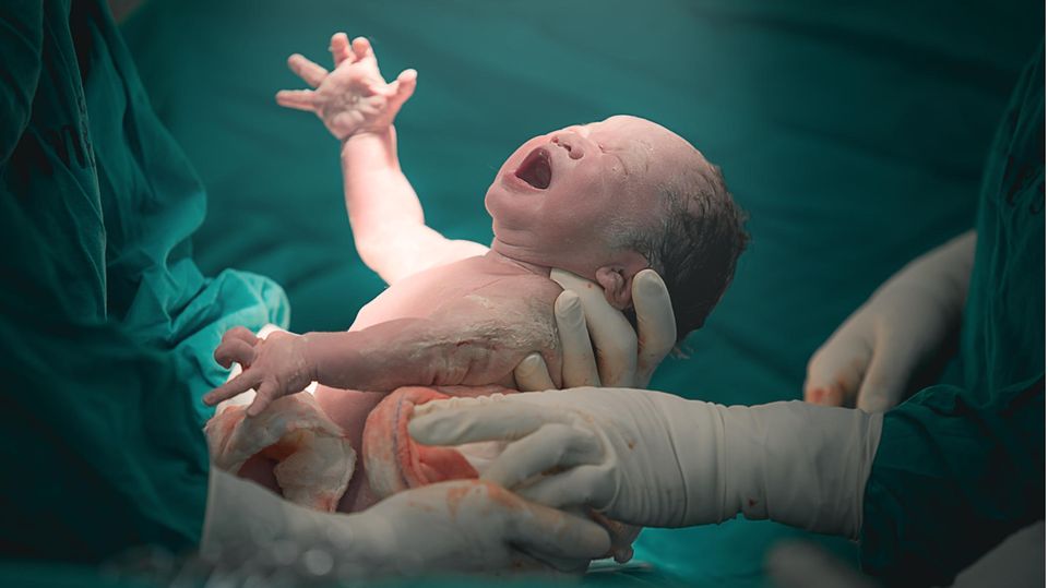 Ein Kind wird per Kaiserschnitt geboren.