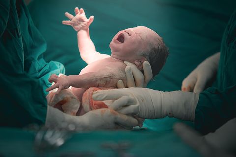 Ein Kind wird per Kaiserschnitt geboren.