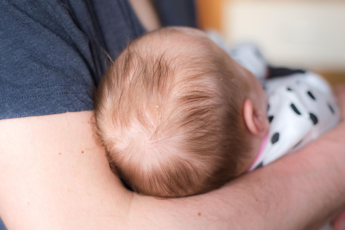 Kopfgneis: Baby mit Kopfgneis