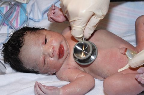 Neugeborenes beim Apgar-Test wird mit Stethoskop untersucht
