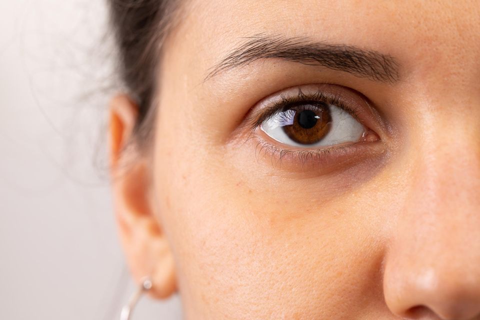 Dunkle Augenringe: Drau mit blauen Augenringen