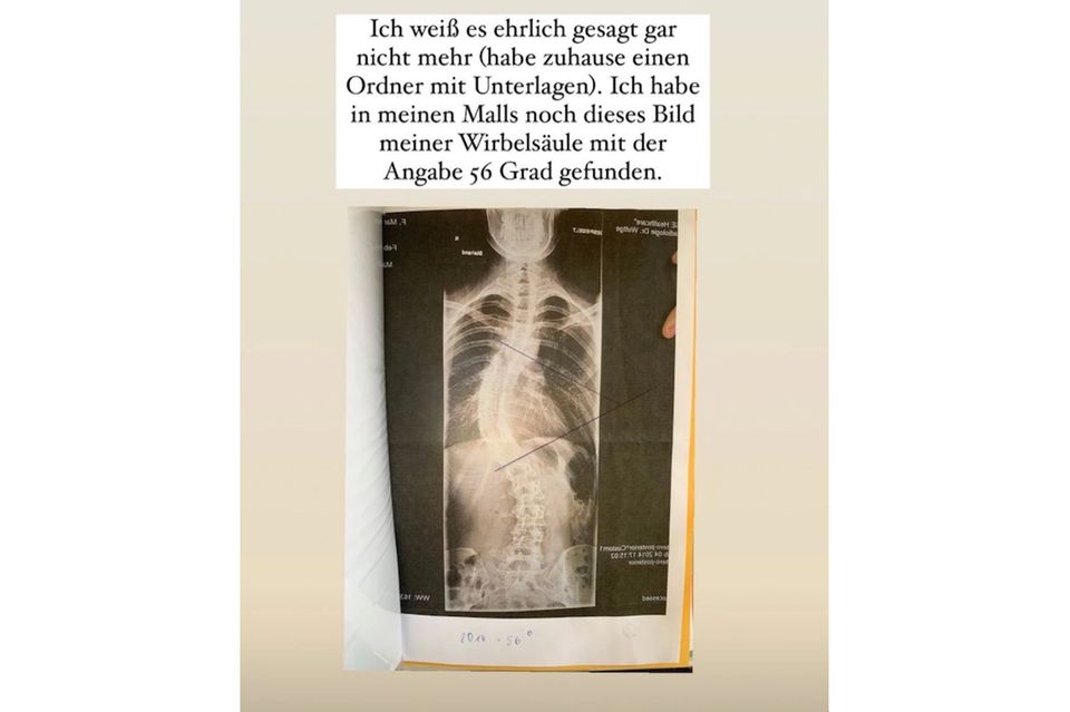 Marie Nasemann über GNTM: ein Röntgenbild eines Rückens
