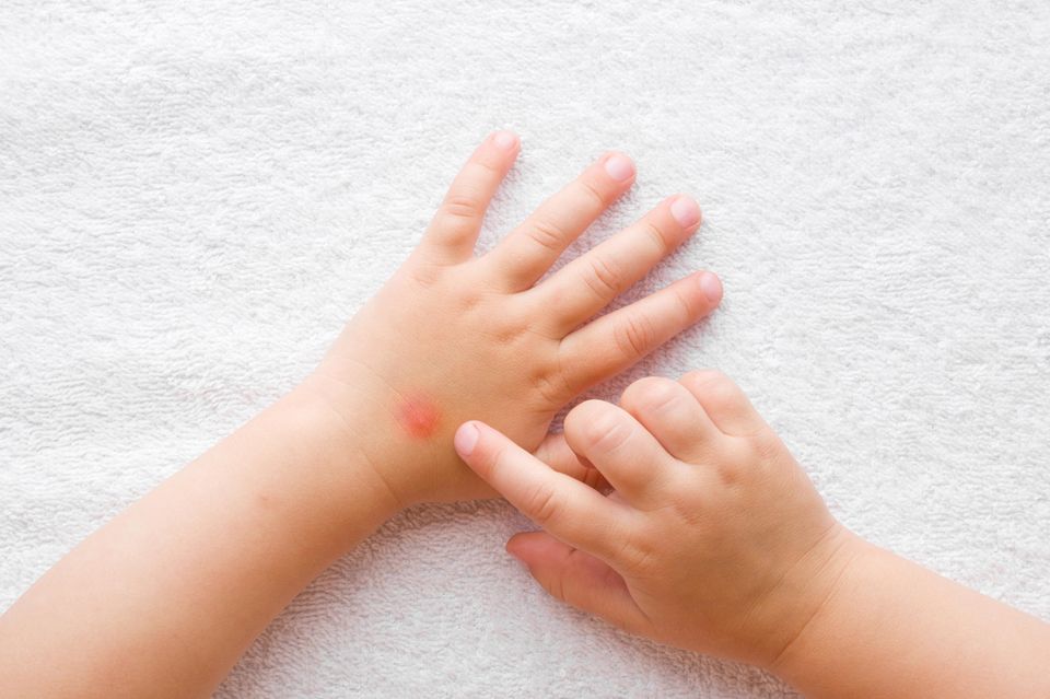 Schutz vor Mücken: Kinderhände mit Mückenstich