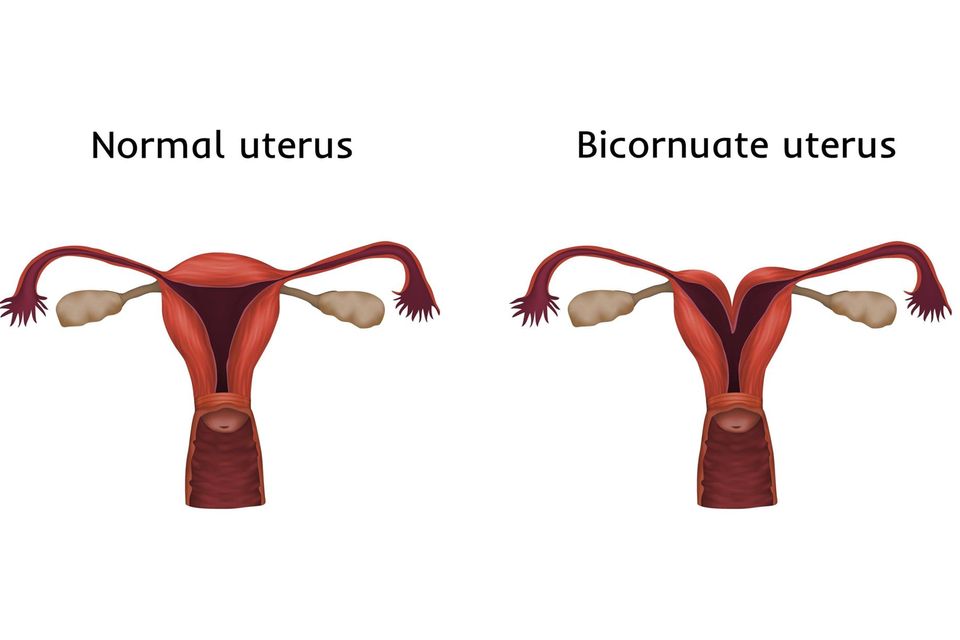 Herzförmige Gebärmutter: Normaler Uterus und herzförmige Gebärmutter