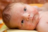 Baby mit Neugeborenenakne im Gesicht