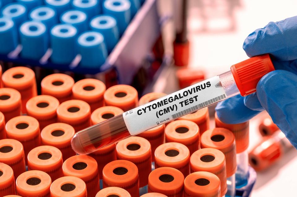 Zytomegalie: Blutprobe-Röhrchen mit Cytomegalovirus Test