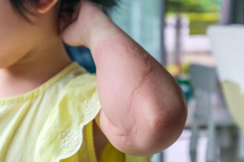 Kleinkind im gelben Kleid hebt Arm mit großer Nesselsucht-Quaddel