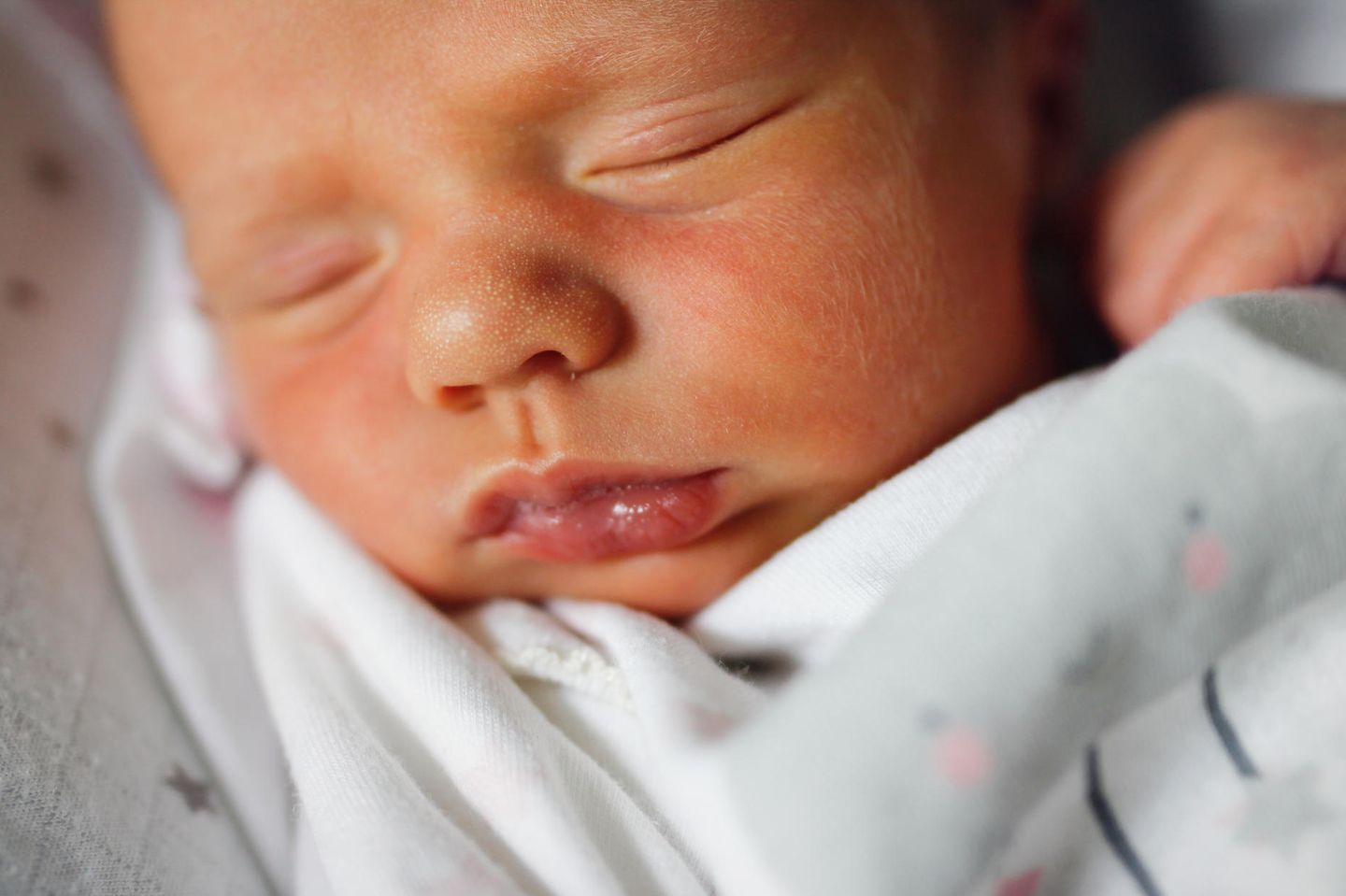 Gesicht eines neugeborenen Babys mit Milien