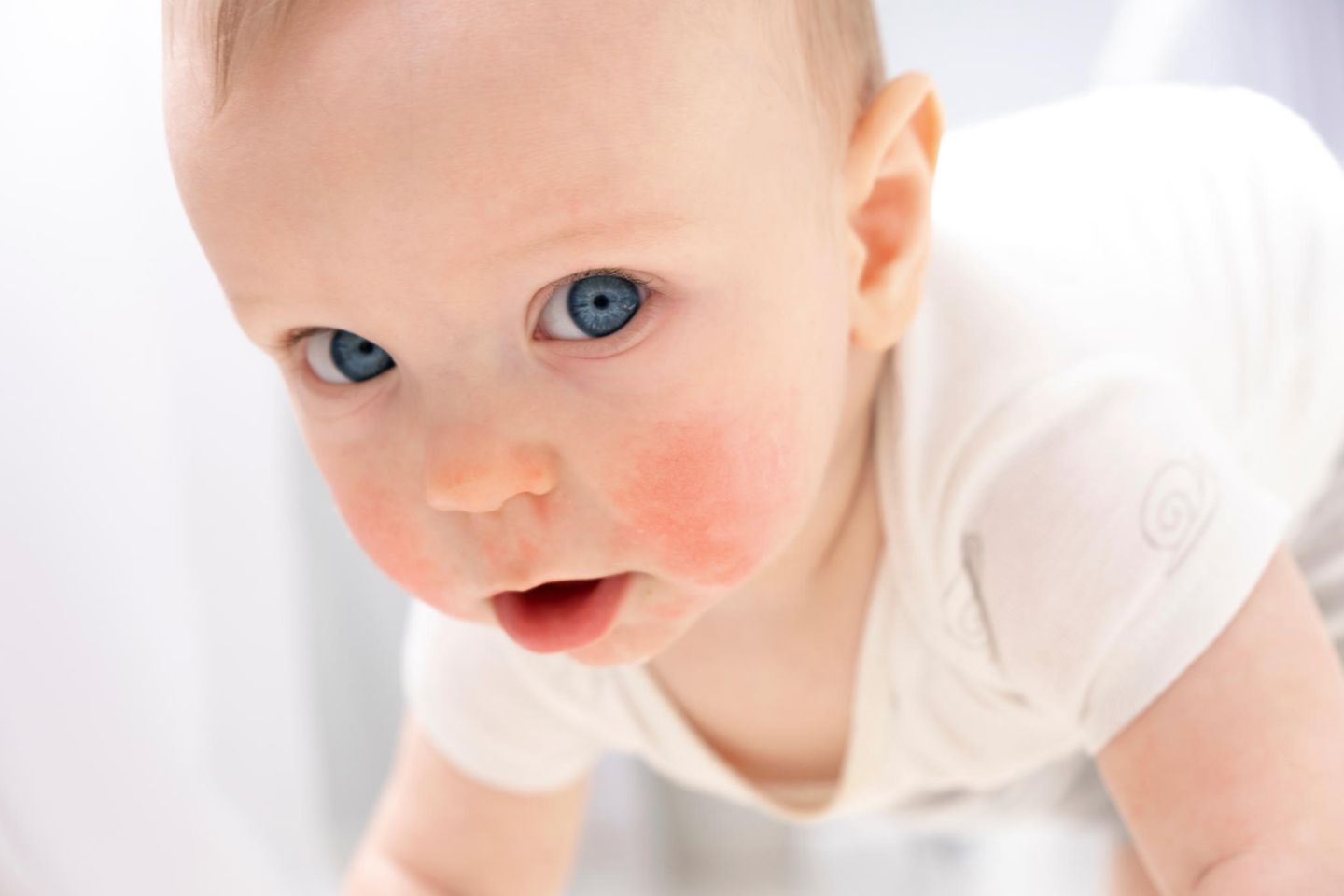 Dennie-Morgan-Falte: Blauäugiges Baby mit Neurodermitis-Anzeichen