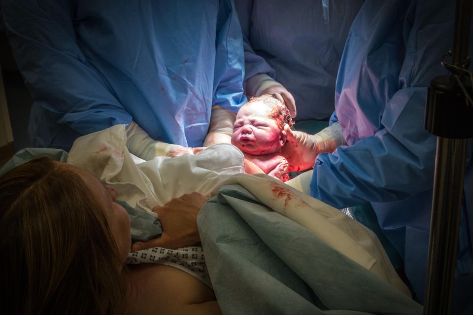Kaisergeburt: Mutter sieht, wie ihr Baby aus ihrem Bauch auf die Welt geholt wird